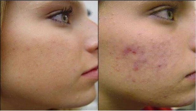 billede-af-før-og-efter-behandling- med-hydro-dermabrasion