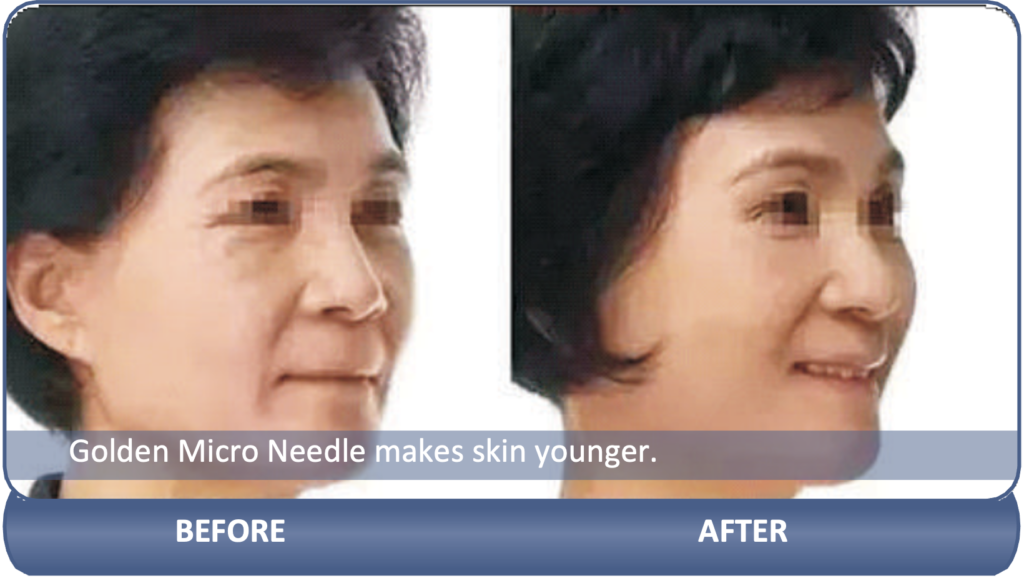 beautystyle-micro-needling-gold